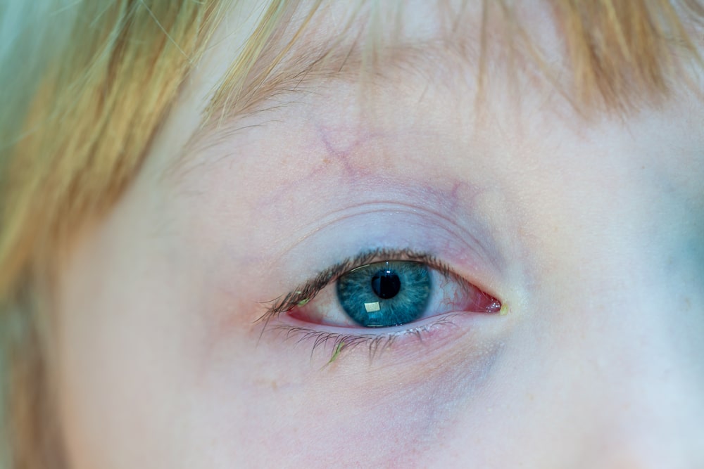 Closeup of irritated red bloodshot eye - conjunctivitis.